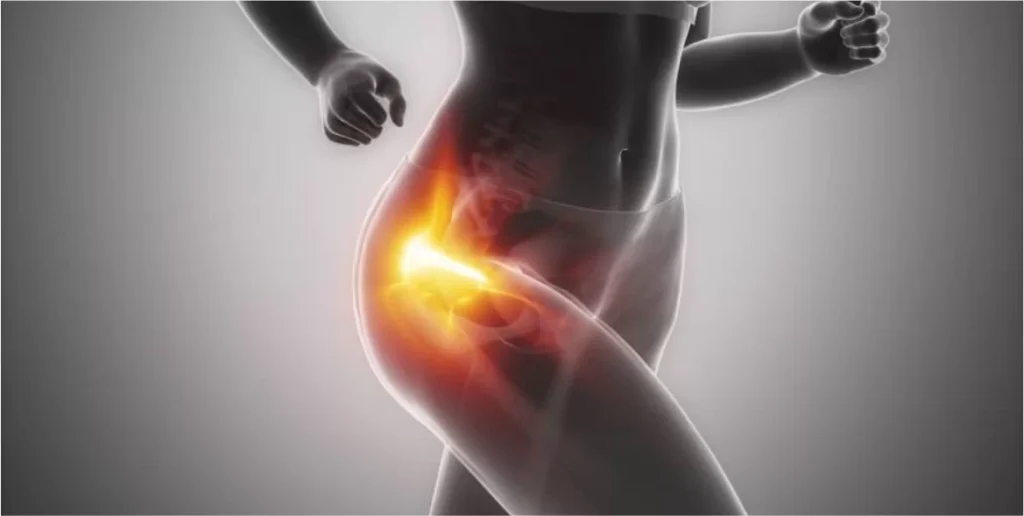 Síndrome Dolorosa do Grande Trocanter