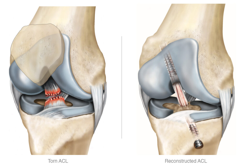 Lesão de Ligamento Cruzado Anterior
