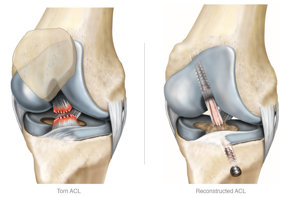 Lesão de Ligamento Cruzado Anterior