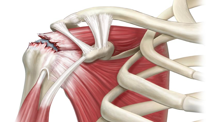 Síndrome do Manguito Rotador