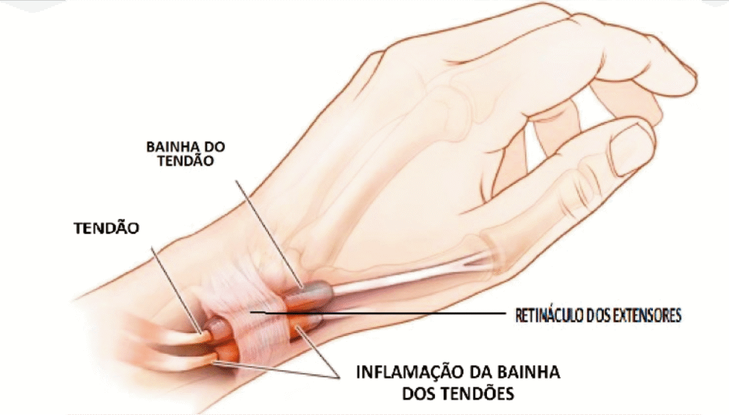 Tenossinovite de De Quervain