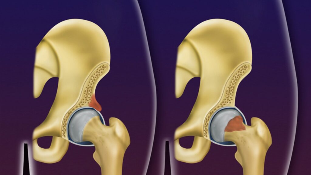 Impacto Femoroacetabular