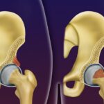 Impacto Femoroacetabular