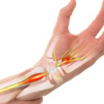 Síndrome do Túnel do Carpo