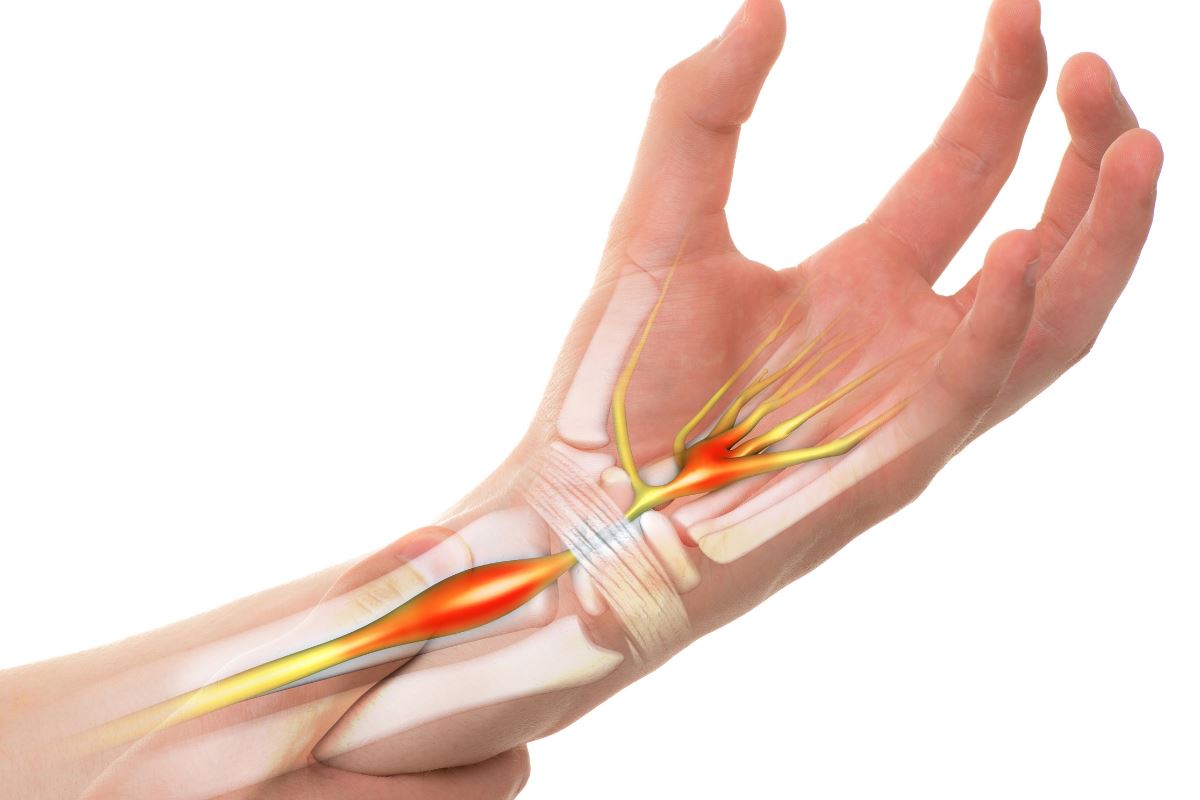 Síndrome do Túnel do Carpo