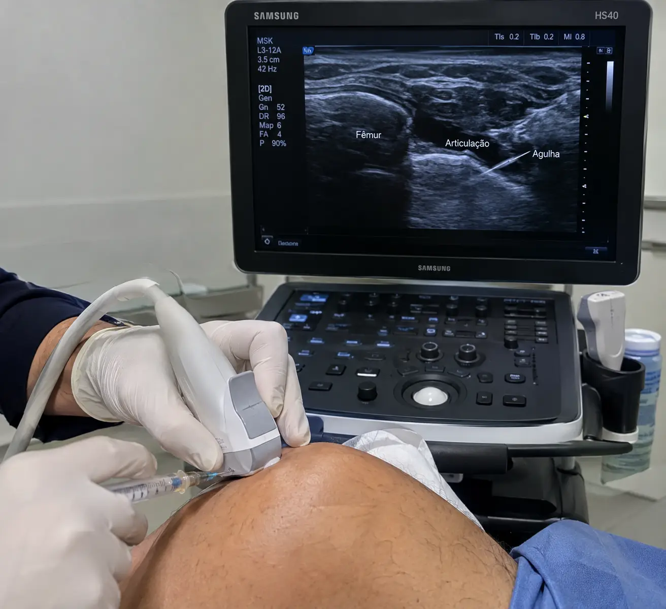 Infiltração guiada por ultrassom